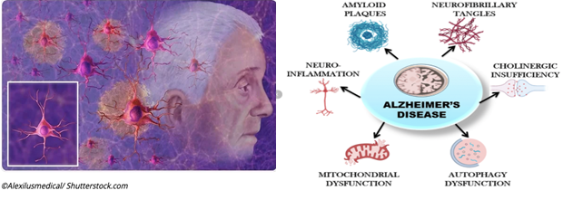 Multiple factors responsible for disease progression